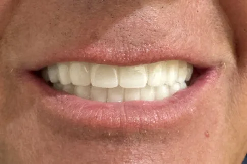 After close-up of restored natural-looking smile