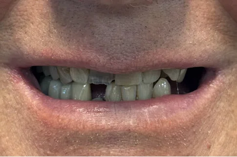 Before close-up of patient smile