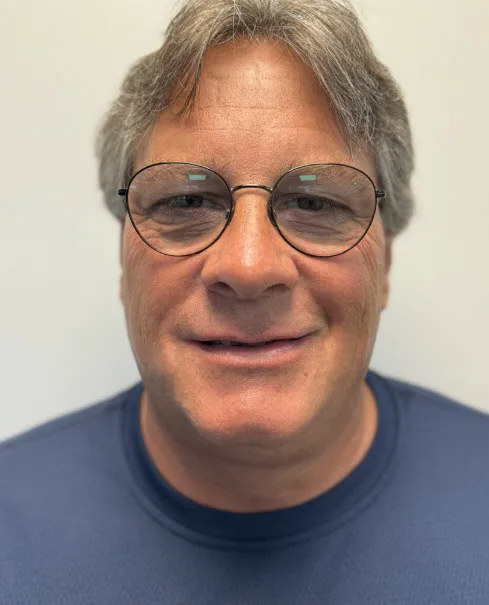 Before full-arch snap-on denture restoration patient portrait