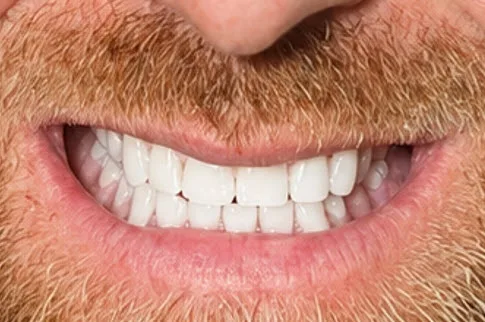 After close-up of restored natural-looking smile