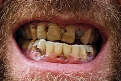 Before close-up showing severely compromised teeth