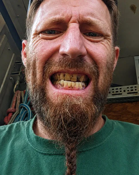 Before implant-supported denture rehabilitation patient portrait