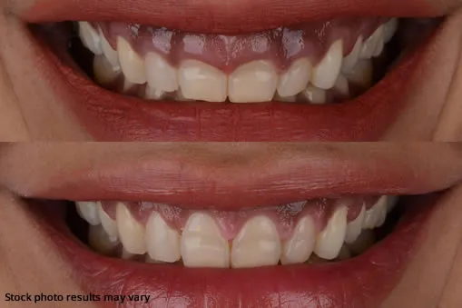 Gum contouring before and after results