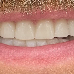Smile Makeover