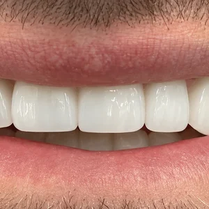 Porcelain Veneers