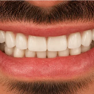 Full-Mouth Restoration