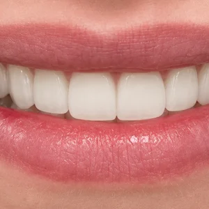 Teeth Whitening