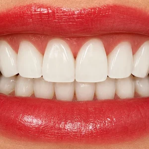 Cosmetic Bonding