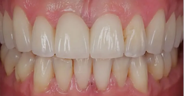Dental crown and bridge restoration