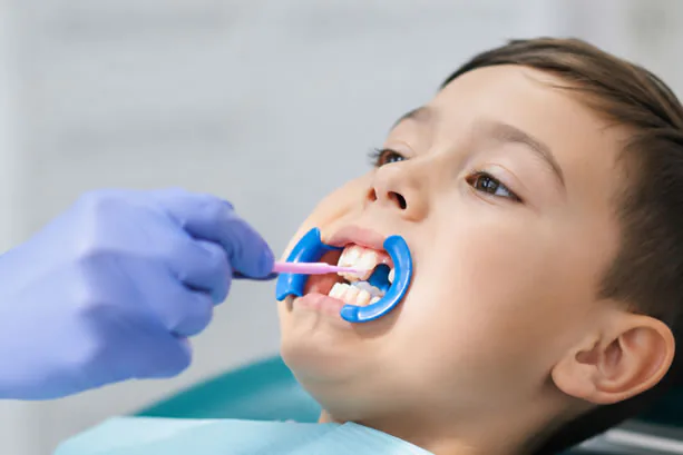 Dental sealants applied to teeth at OC Premier Dentistry